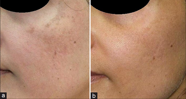 B&A Pigment Removal