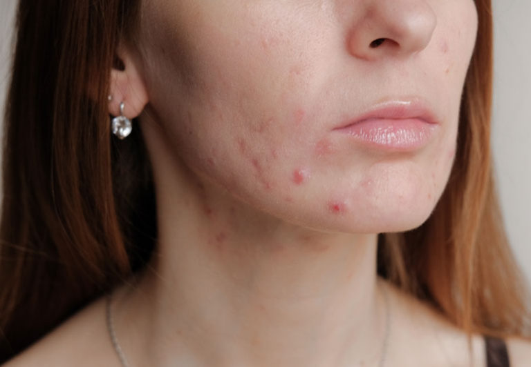 does-stress-cause-acne-proven-investigates-dermaquip